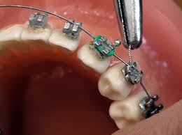 Phase I Orthodontics