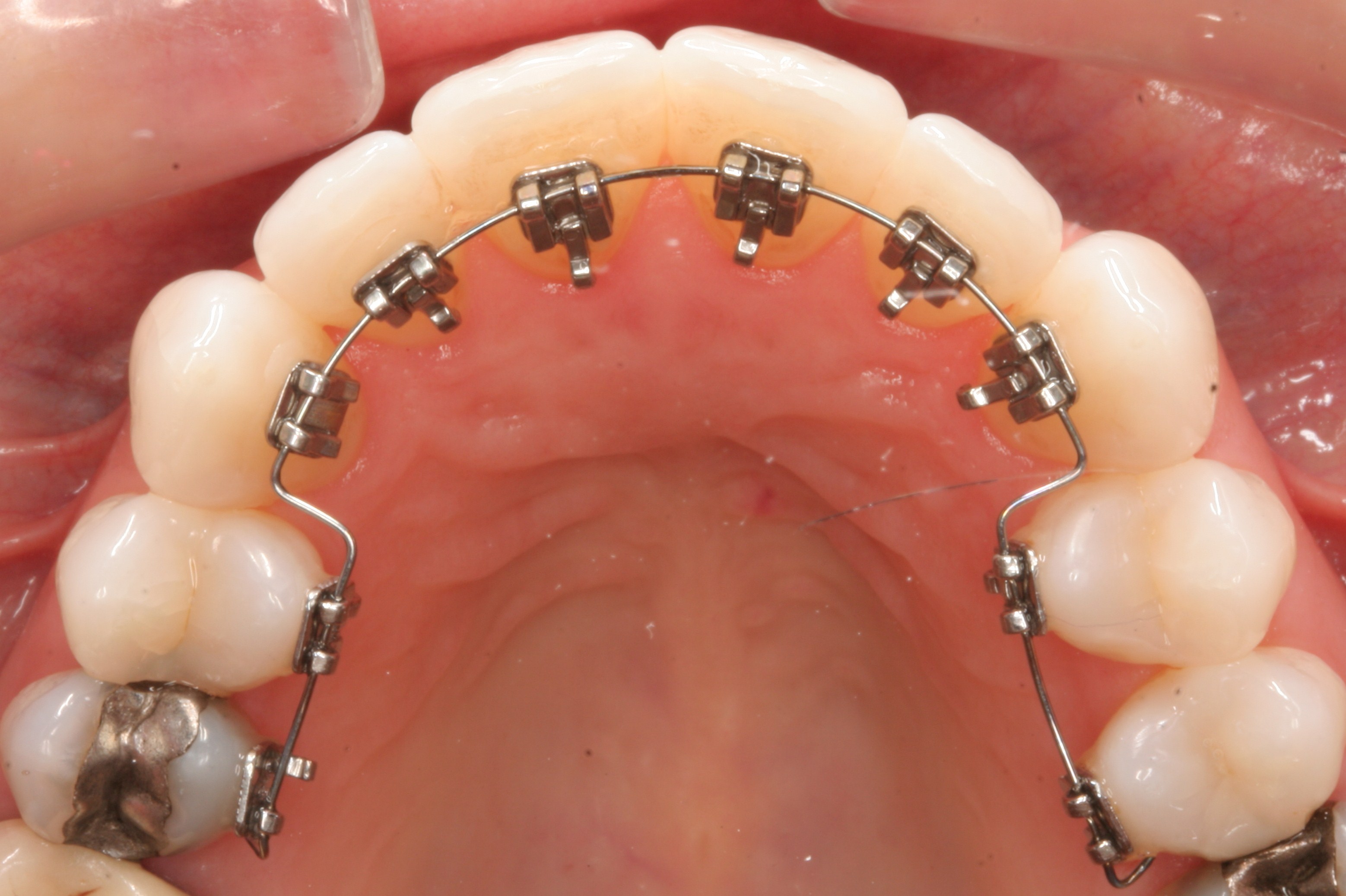 Los Angeles Orthodontist: Try Our Lingual Braces Quiz