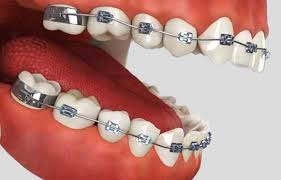 teeth-with-metal-braces