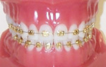 braces_gold