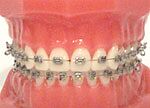 braces_stainless
